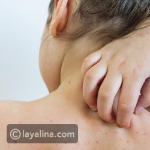 جدري القرود .. تعرف علي أسباب و أعراض الجائحة الجديدة