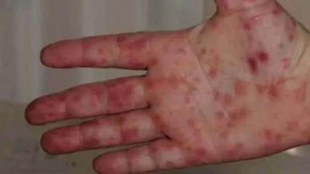 إنفلونزا الطماطم .. فيروس جديد ينضم للساحة و تحذيرات من وزارة الصحة