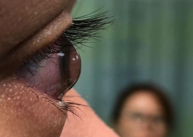 ما هي أسباب الإصابة بالقرنية المخروطية؟