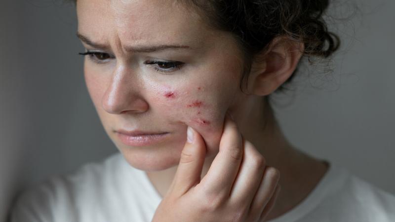 مثلث الموت.. كيف يمكن للبثور في الوجه أن تهدد حياتك